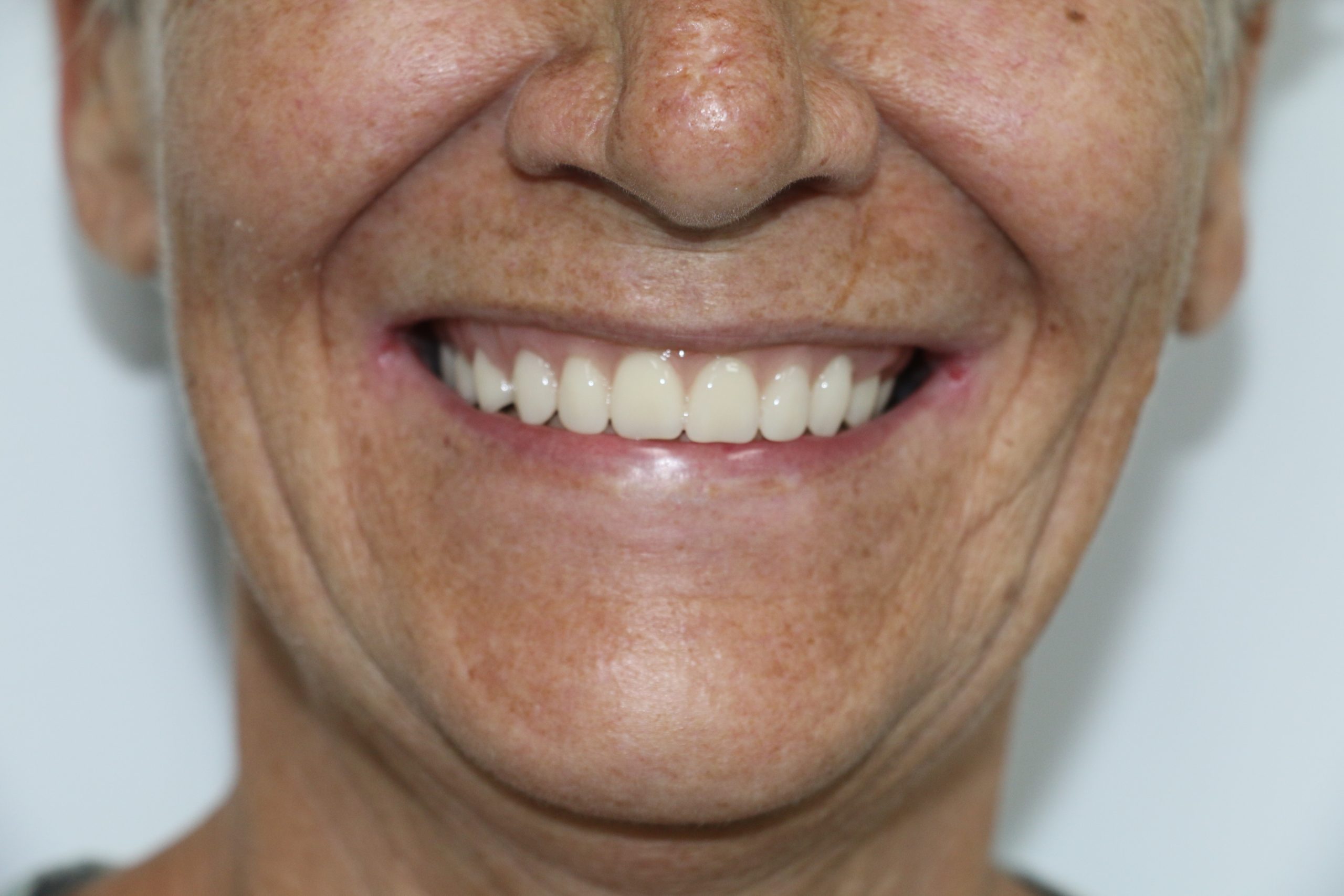 After denture