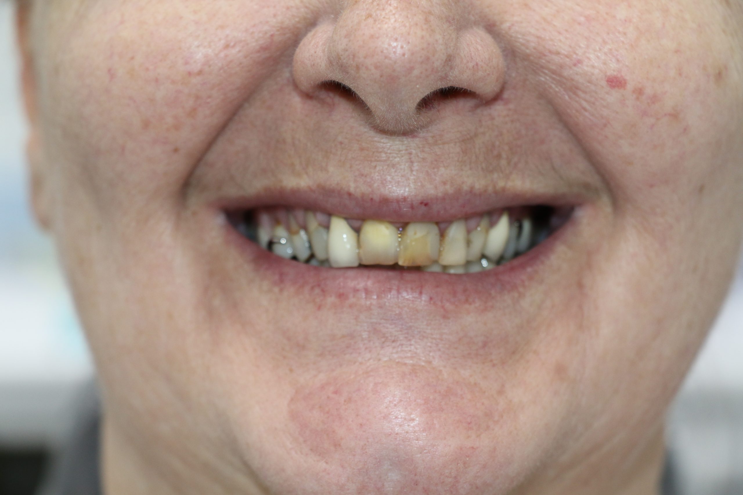 Before smile designing Before smile designing