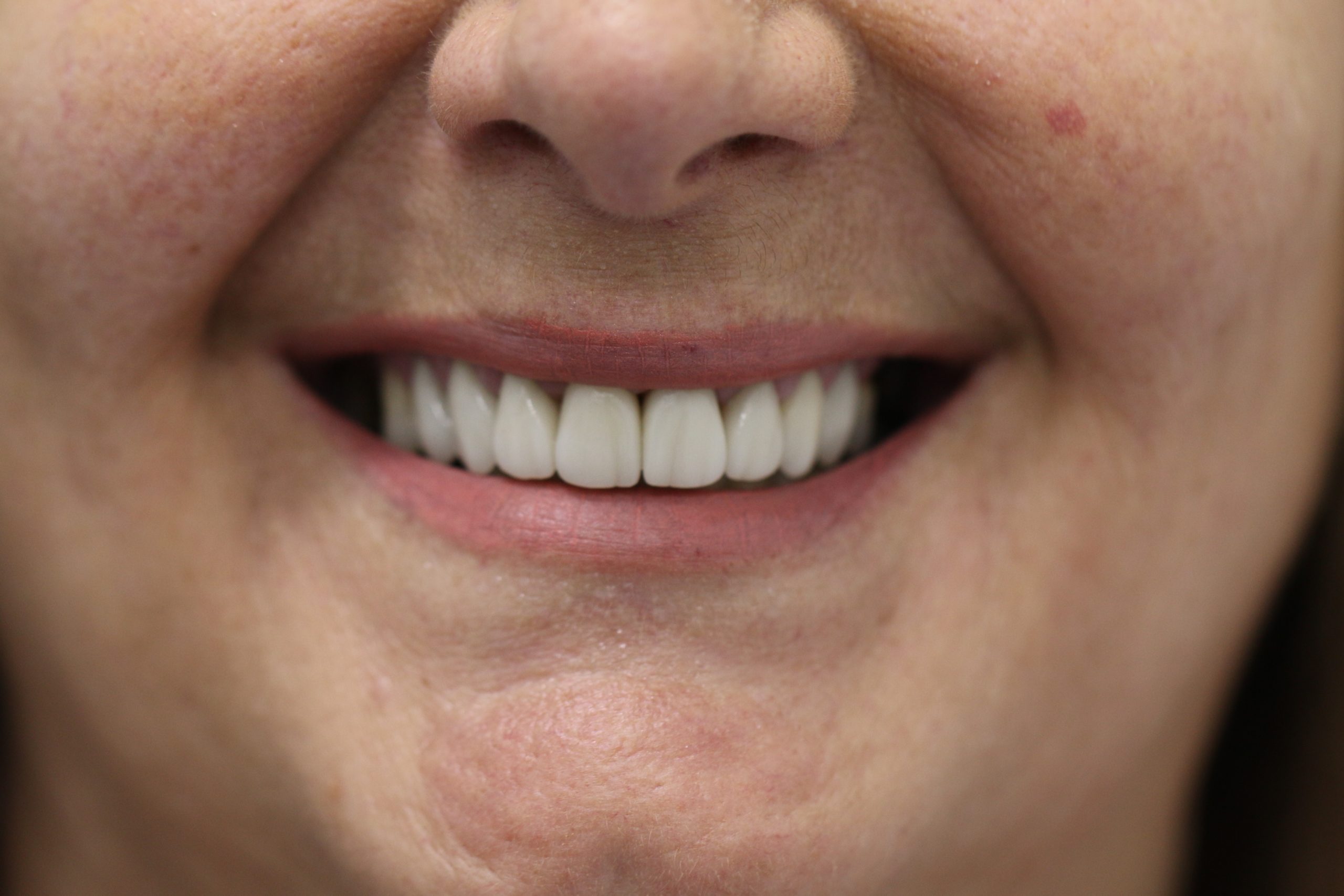 after smile designing