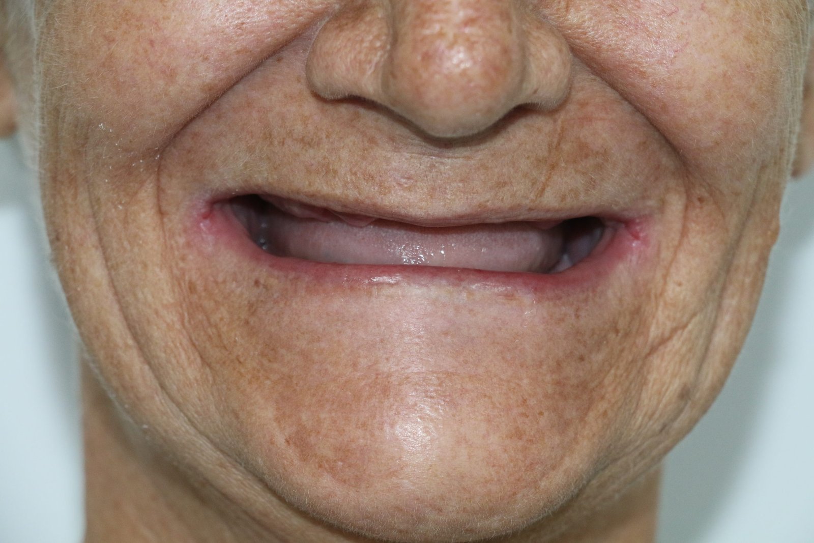 Before-denture-scaled.jpg Before-denture-scaled.jpg