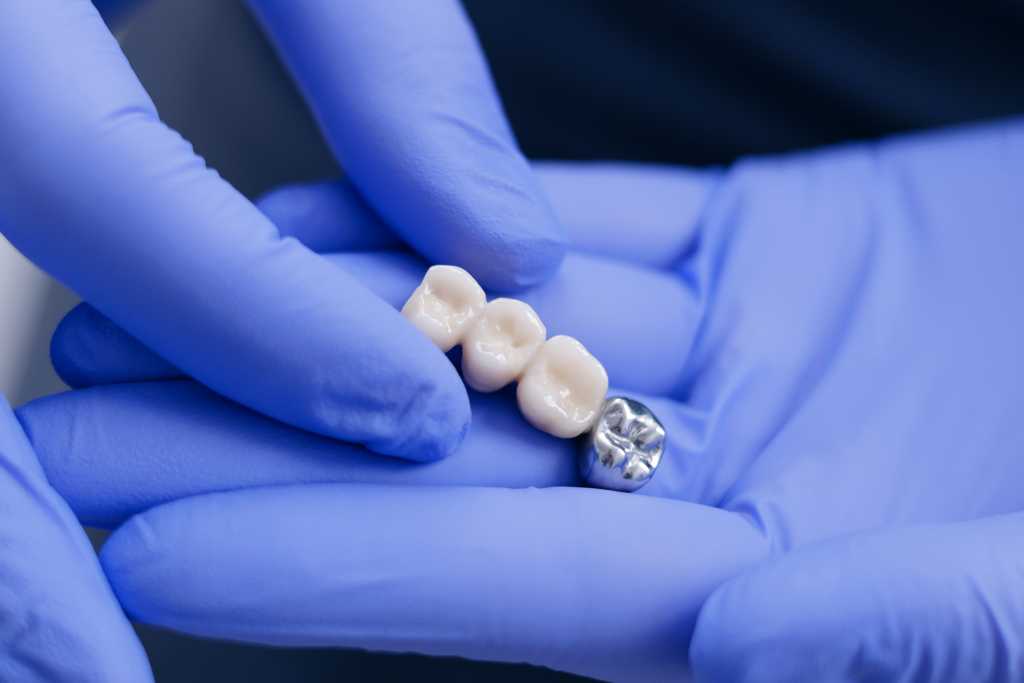 Gloved hand holding a dental bridge with three ceramic crowns and one polished metal abutment — restorative dentistry at Dentist at Underwood