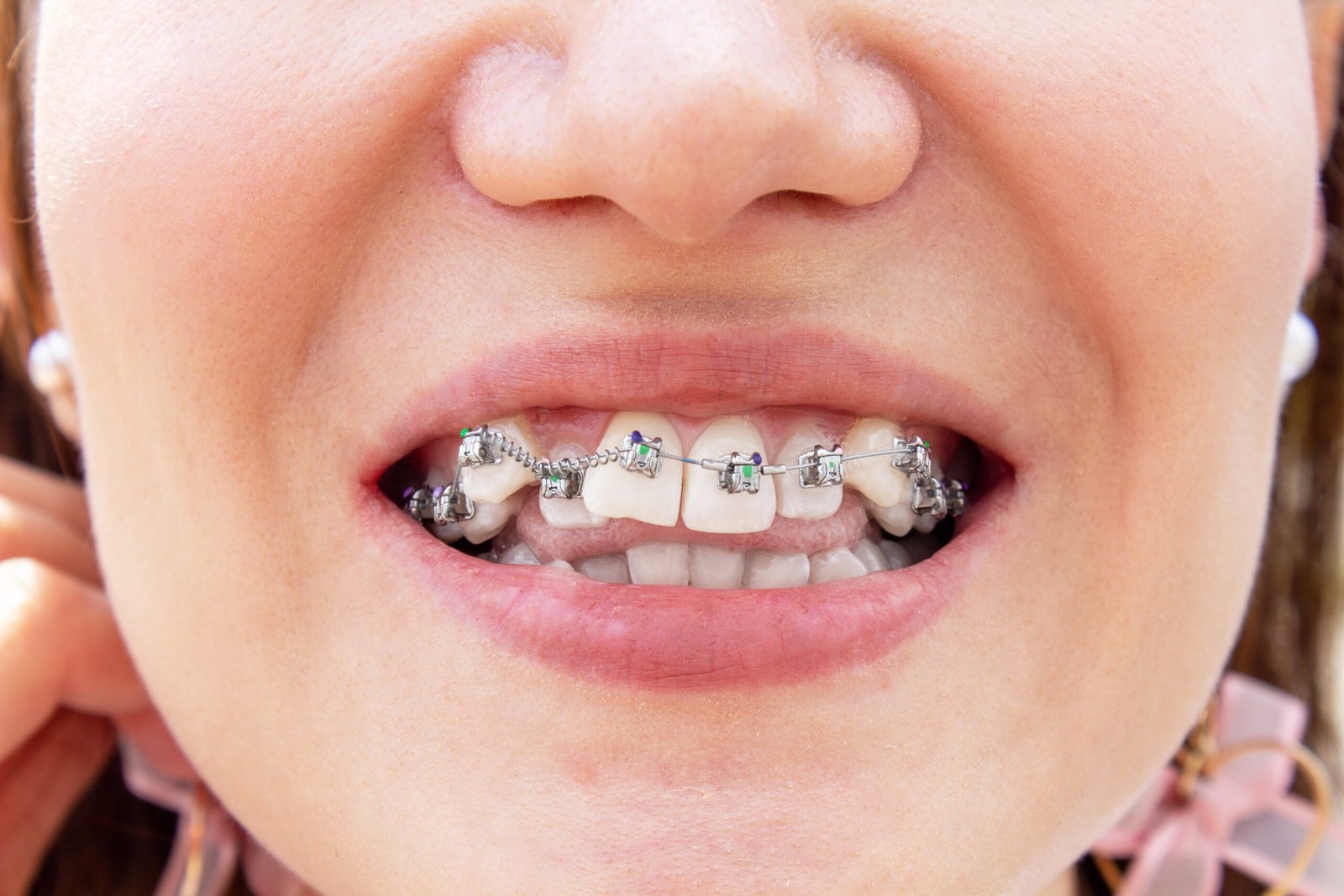 Detailed view of metal braces used to correct tooth crowding and alignment for a straighter smile.